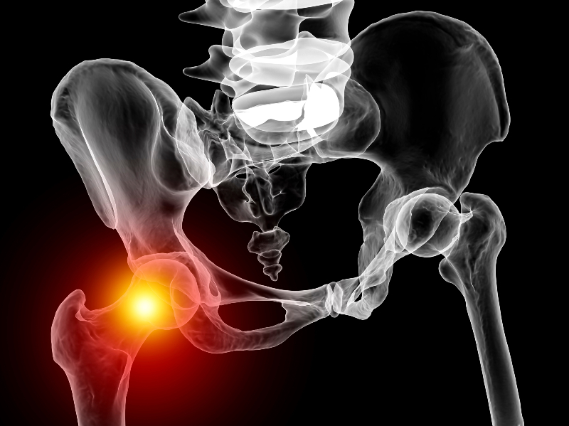 Making Ergonomic Changes and Hip Replacement in Austin, TX Eases Pain