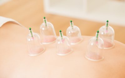 Understanding Cupping Therapy in Minnetonka, MN: What is it and How Does it Work?