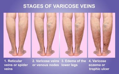 Varicose Vein Removal in Schaumburg – What You Should Know?