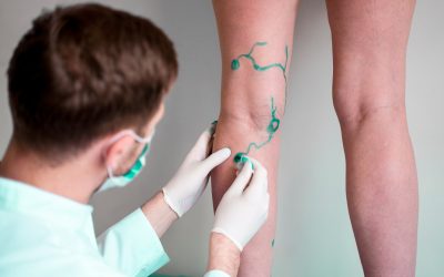 The Top Benefits Of A Vein Treatment In New York